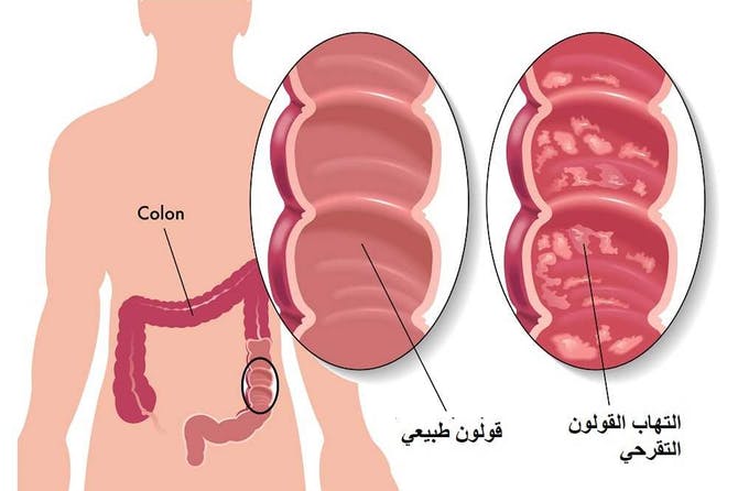 اسباب التهاب القولون الهضمي - اعراض القولون الهضمي واهم اسبابه 11192