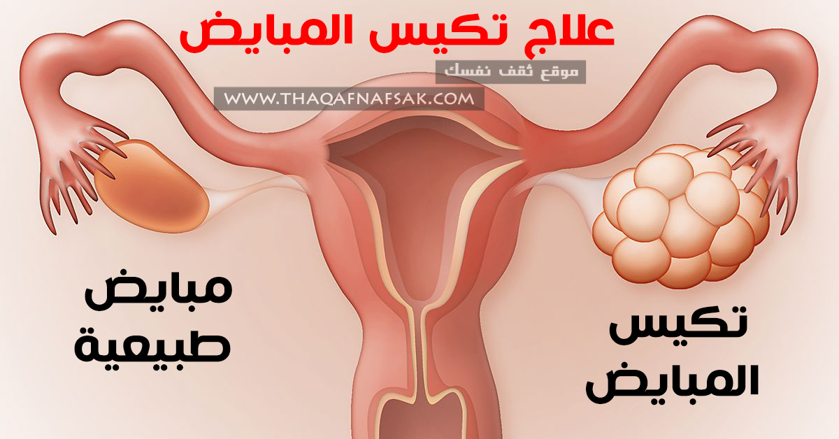 أعراض تكيسات المبايض وعلاجها - علاج تكيس المبايض 6940 1