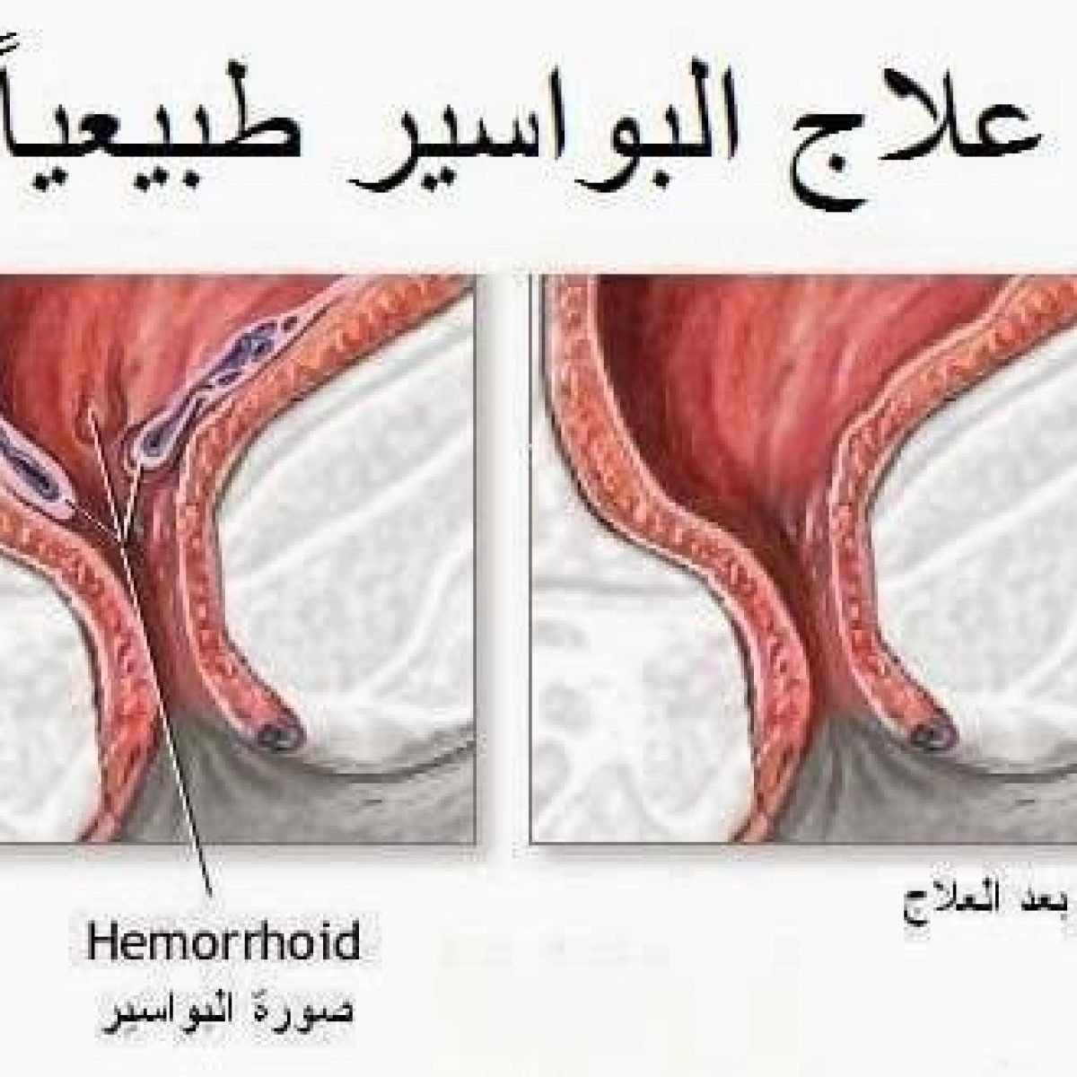 علاج البواسير - بدون اى عمليات جراحيه تخلص من هذه المشكله 2299 1