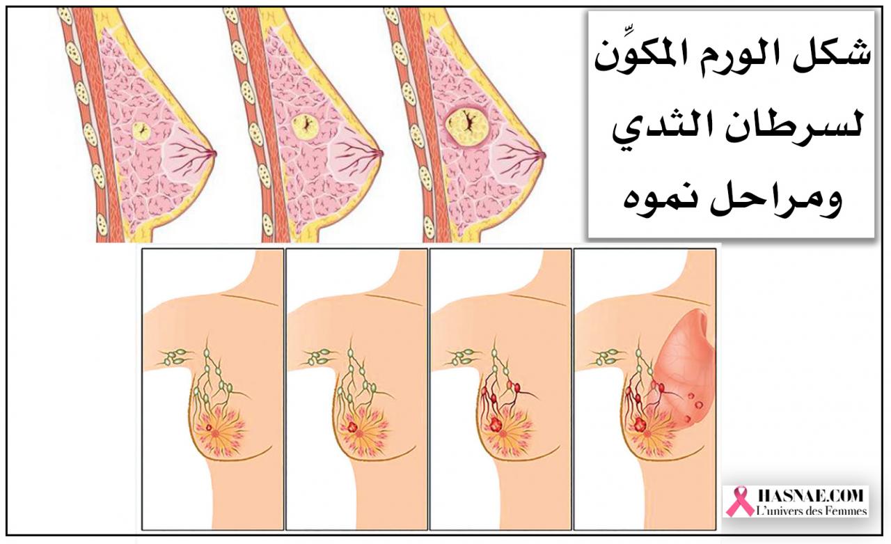 بداية سرطان الثدي - اعراض سرطان الثدي 7255