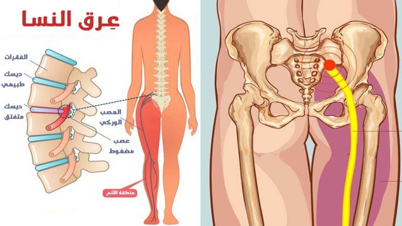 علاج عرق النسا في الطب النبوي - التخلص من مرض عرق النسا 6787