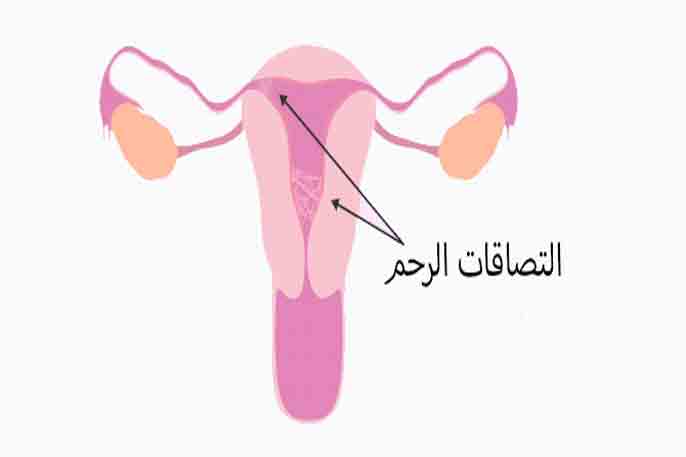 الحمل مع وجود التصاقات في الرحم - كيف يحصل الحمل في وجود التصاقات 6372