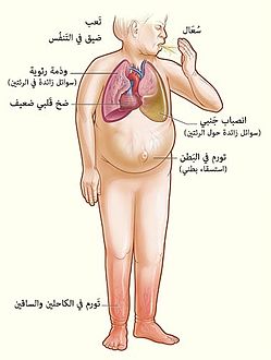 اعراض مرض القلب , ازاي اعرف اني عندي القلب