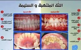 افضل الطرق الطبيعيه علاج اللثه الملتهبه - علاج اللثة الملتهبة 6285 2