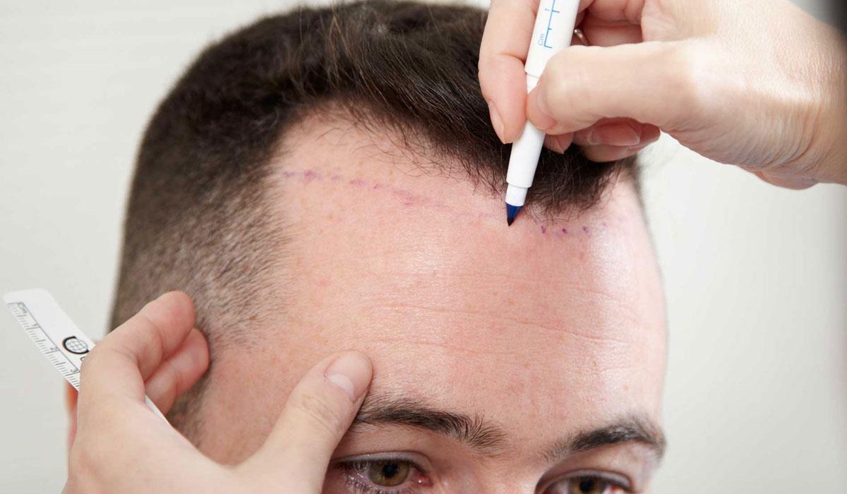 زراعة الشعر في الكويت , من اشهر المراكز الطبيه المتخصصه لزراعه الشعر