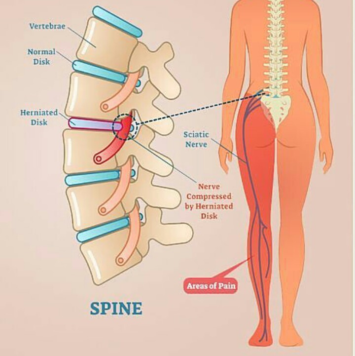 علاج عرق النسا في الطب النبوي - التخلص من مرض عرق النسا 6787 1