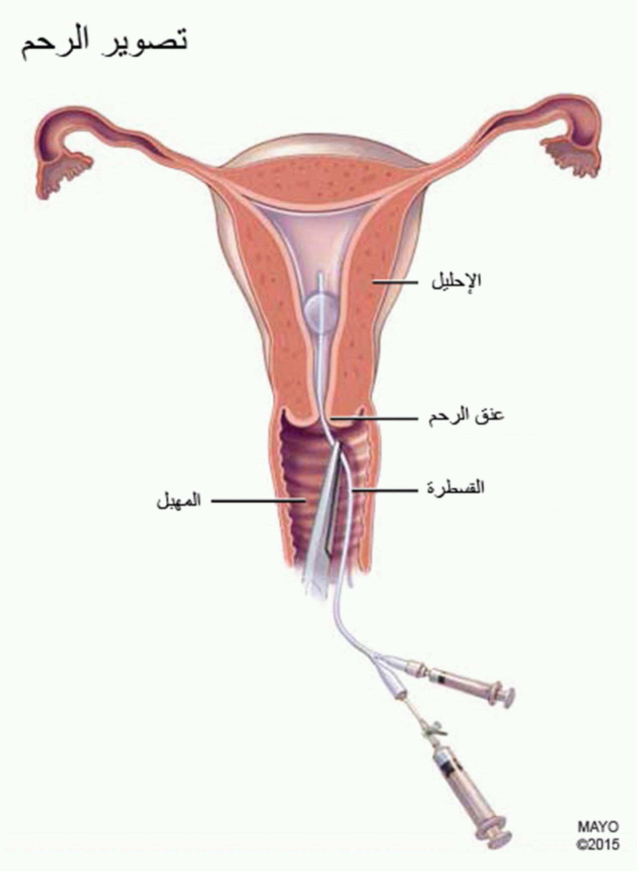 علاج تليف الرحم - اسباب تلف الرحم وطرق علاجه وكيفيه علاجه 7107