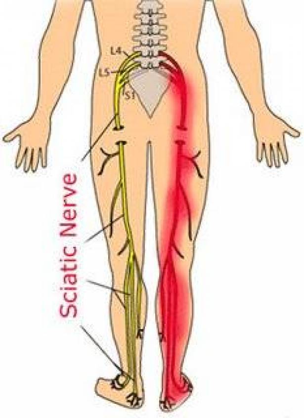 علاج عرق النسا في الطب النبوي - التخلص من مرض عرق النسا 6787 2