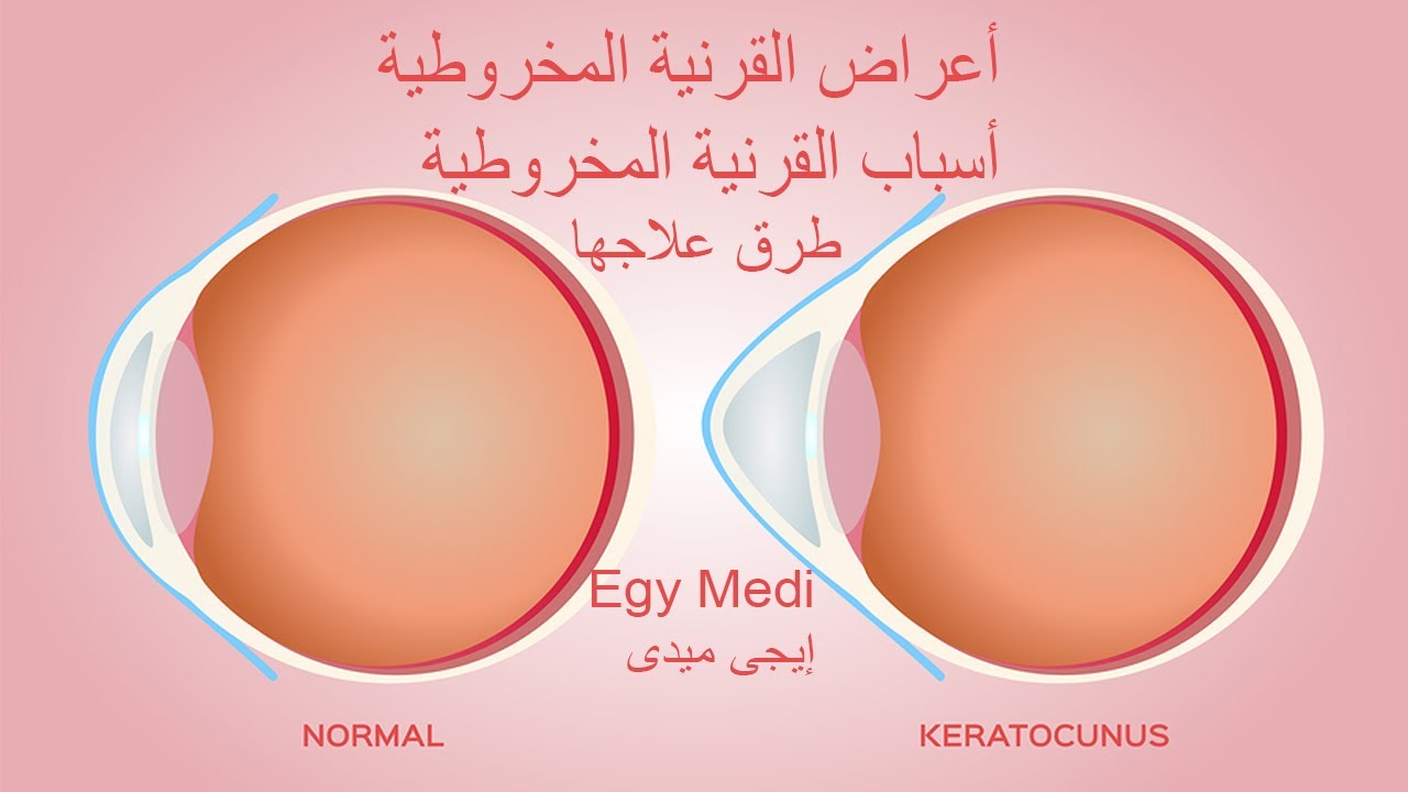 اعراض القرنية المخروطية - اسباب القرنيه واعراضها وكيفيه علاجها 11175 1