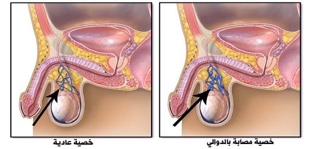 عملية دوالي الخصية - معلومات عن عملية الدوالي 6676 2