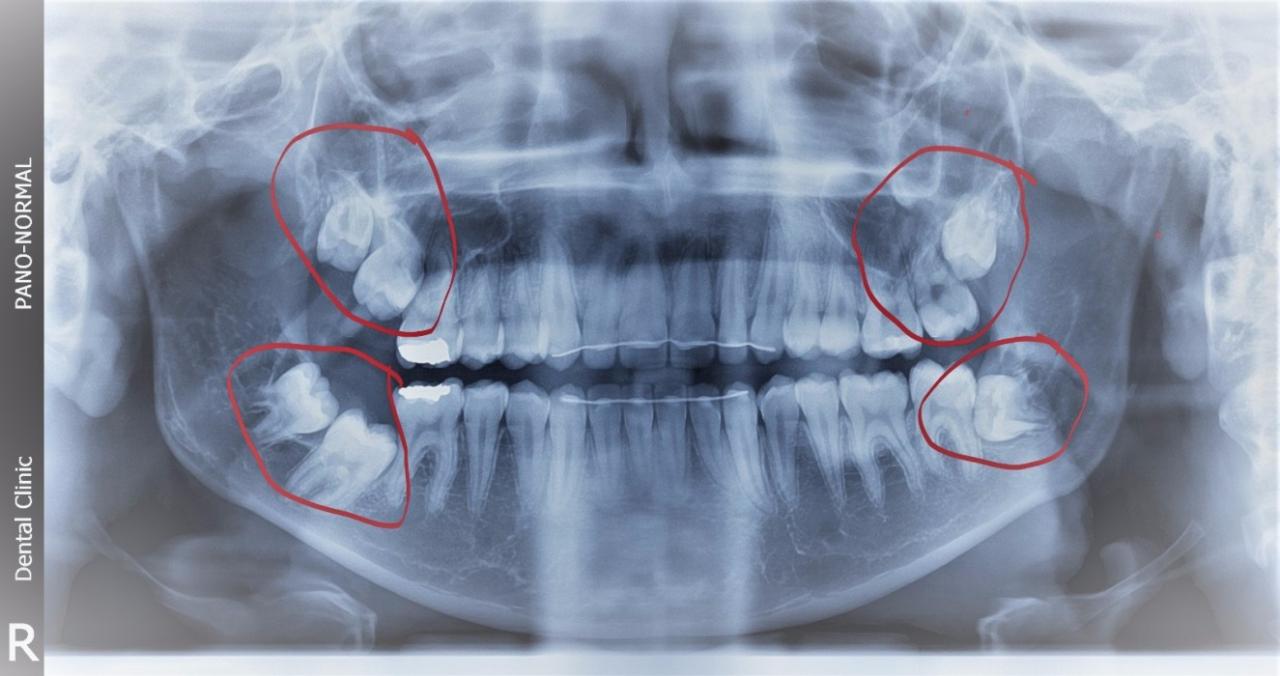 صور ضرس العقل - ما هو ضرس العقل ومتي يظهر 7479 4