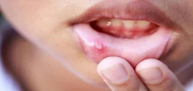 6481 2 علاج قرحة الفم واللثة - الأمراض التي تصيب الفم فهد ساكت