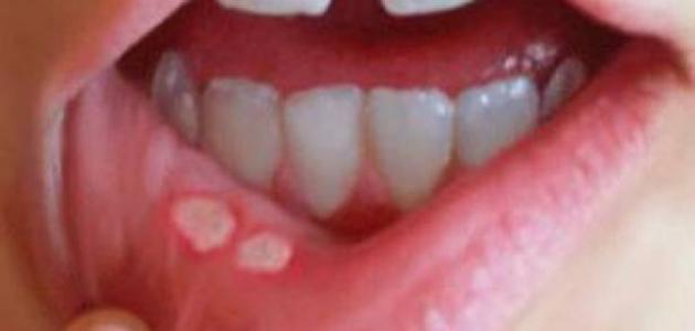 6481 علاج قرحة الفم واللثة - الأمراض التي تصيب الفم فهد ساكت