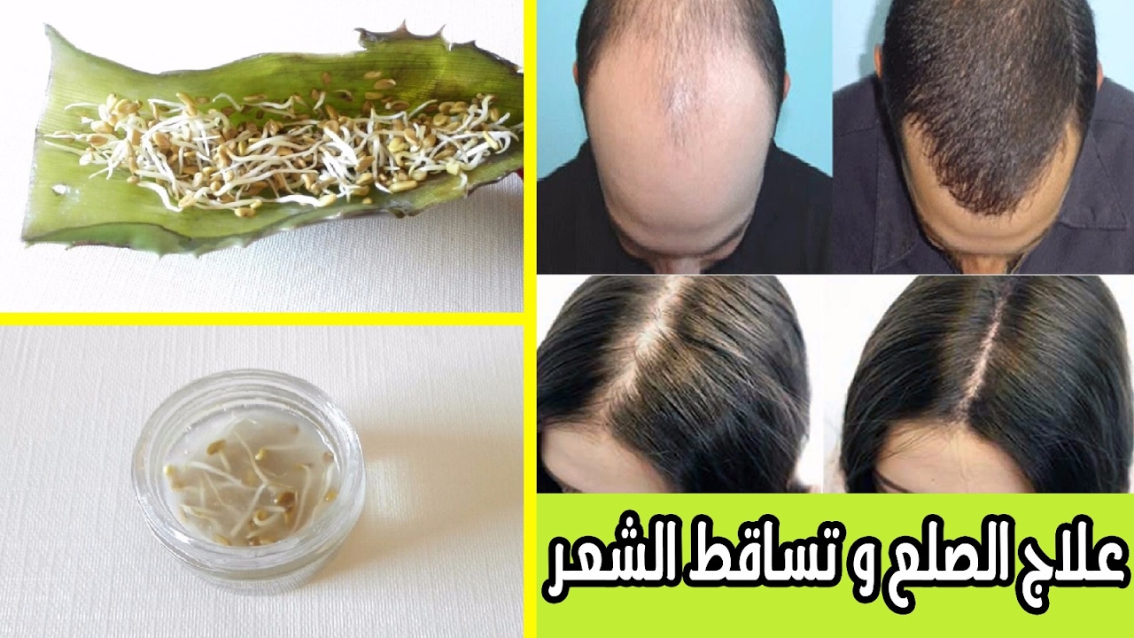 7234 1 علاج الصلع وتساقط الشعر - كيفيه علاج الصلح وعلاج تساقط الشعر نوف