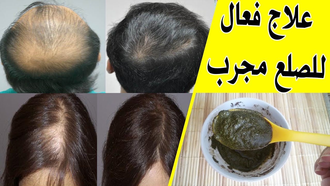 7234 2 علاج الصلع وتساقط الشعر - كيفيه علاج الصلح وعلاج تساقط الشعر نوف