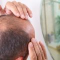 7234 3 علاج الصلع وتساقط الشعر - كيفيه علاج الصلح وعلاج تساقط الشعر نوف