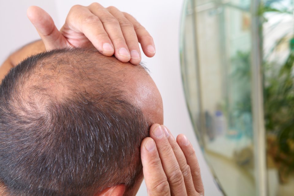 7234 علاج الصلع وتساقط الشعر - كيفيه علاج الصلح وعلاج تساقط الشعر نوف